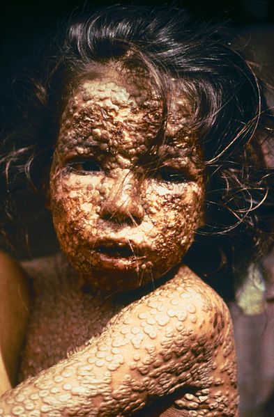Ficheiro:Child with Smallpox Bangladesh.jpg
